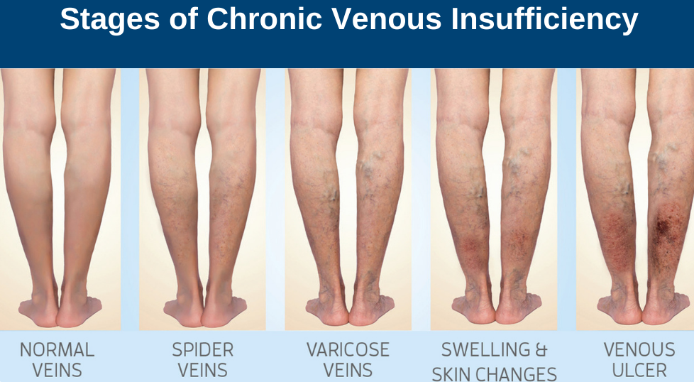 chronic venous insufficiency